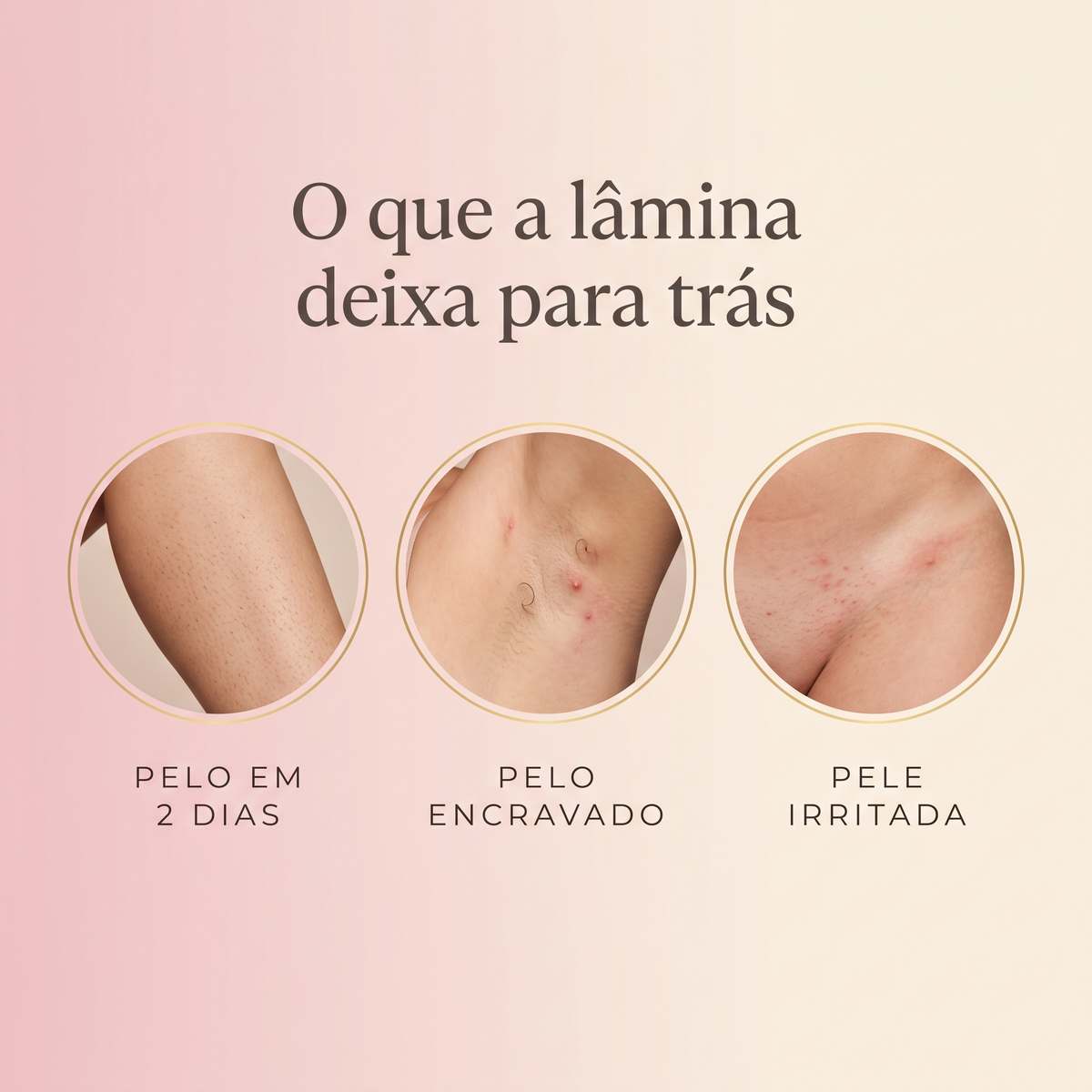 O que a lâmina deixa para trás — pelo em dois dias, pelo encravado e pele irritada
