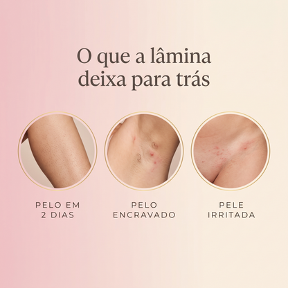 O que a lâmina deixa para trás — pelo em dois dias, pelo encravado e pele irritada